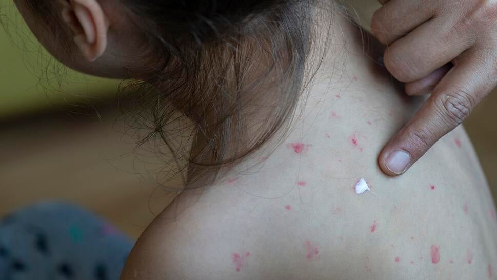 Child With Measles