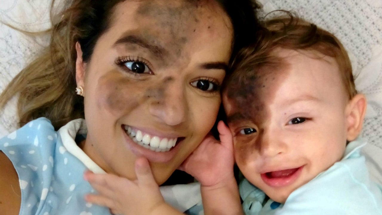 Mom Uses Makeup to Match Son's Facial Birthmark Inside Edition