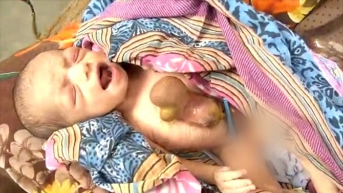 Girl Survives Being Born With Heart Beating Outside Chest ...