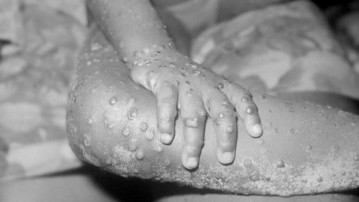 Monkeypox, A Member Of The Orthopox Family Of Viruses, Is An Infection Accidentally Transmitted To Humans Due To Its Similarity To The Smallpox Virus.