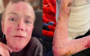 Kansas TikToker Named Marky Jaquez Dies at 21 From Rare ‘Butterfly Skin’ Disease
