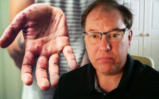 Man Who Got Monkeypox in 2003 Outbreak Describes Symptoms as Virus Spreads