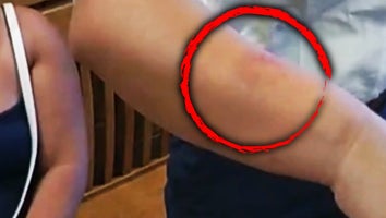 Bite mark on woman's forearm