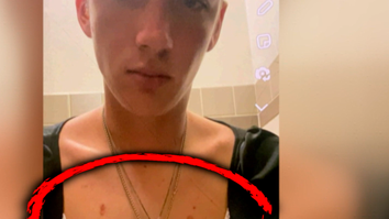 Sawyer Updike with burns on his chest