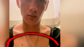 Sawyer Updike with burns on his chest