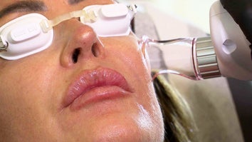 Close up of a woman's face wearing goggles and getting CO2 laser