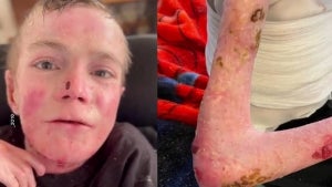 Kansas TikToker Dies at 21 of Rare Genetic Disease That Causes Skin to Blister