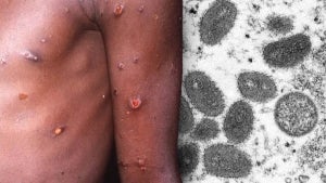 Cases of Rare Monkeypox Virus Reported in at Least 11 Countries