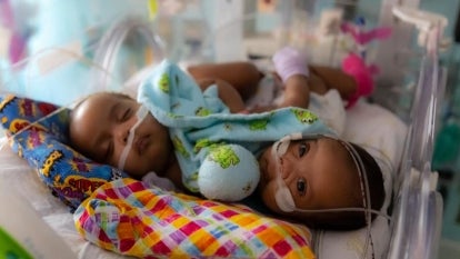 Conjoined Twins Successfully Separated