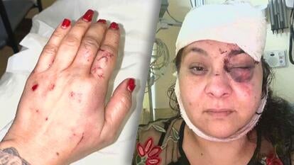 woman shows off bruises