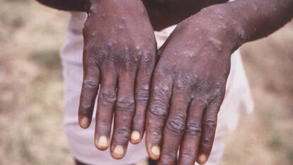 Mpox Outbreak in Africa Prompts Global Response