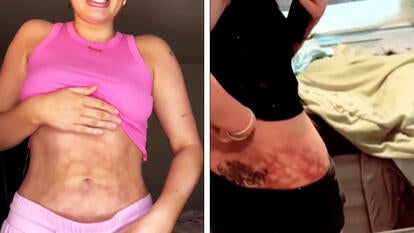 "Toasted skin syndrome" is a little-known medical condition triggering red flags during extreme cold weather.