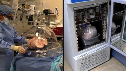 Putting Lungs in a Box or Fridge Increased 2024 Transplants