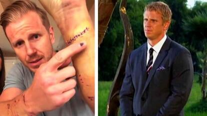 Sean Lowe showing stitches from a dog bite / Sean Lowe on ‘The Bachelor’