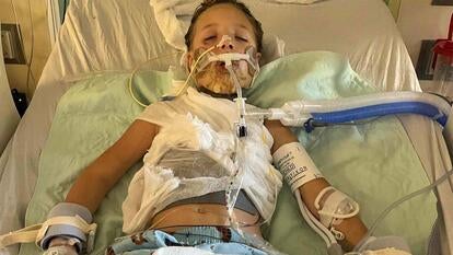7-year-old Scarlett suffered burns