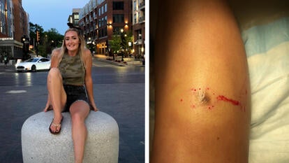 Brittanny Groover / a mole on leg