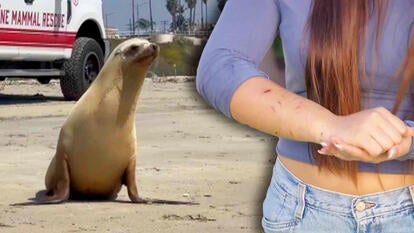 Sealion on beach / Young woman showing bite marks on her arm
