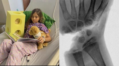 Leah Lindell recovering in hospital bed with stuffie and cheese-shaped cast, X-ray of Lindell's shark-bitten hand