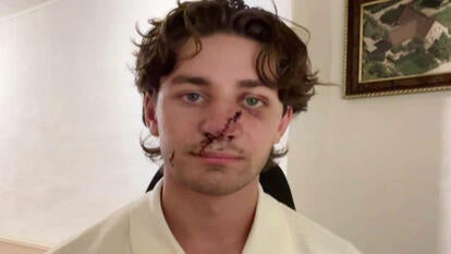 Man sitting looking into camera with a large jagged wound across his face from his left eye to the right side of his mouth