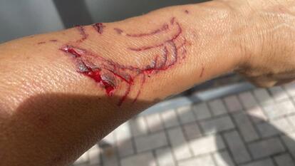 alligator bite on forearm