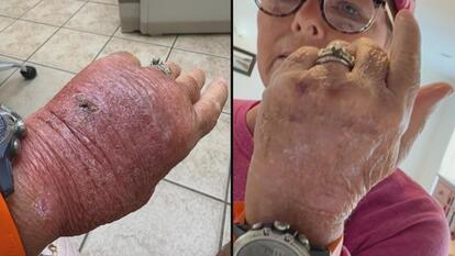 Melinda Howard's infected hand (left), healing (right)