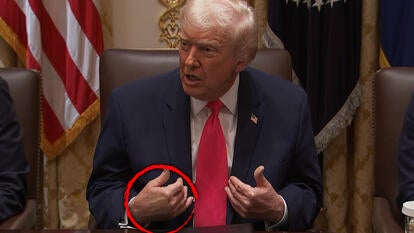 Donald Trump with band-aids on right hand