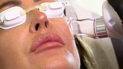 Close up of a woman's face wearing goggles and getting CO2 laser
