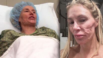Brandi Glanville prepping for surgery / Brandi Glanville's selfie showing facial disfigurement 