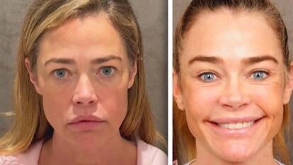 'Before' image of actress Denise Richards with neutral expression / 'After' image of actress Denise Richards smiling