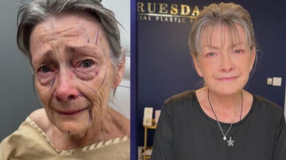 Before and after photos of a woman who had facelift
