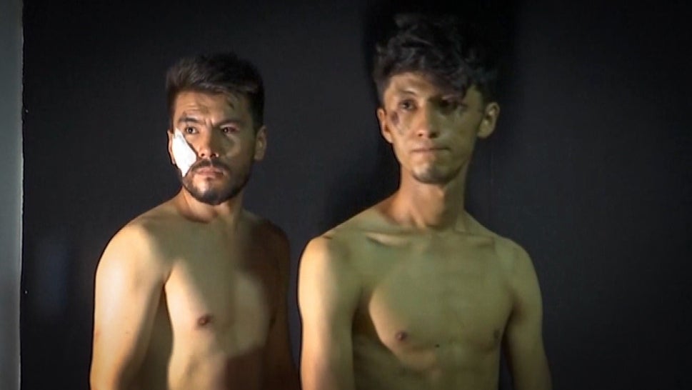 Journalists Show Bruises After Being Beaten by the Taliban