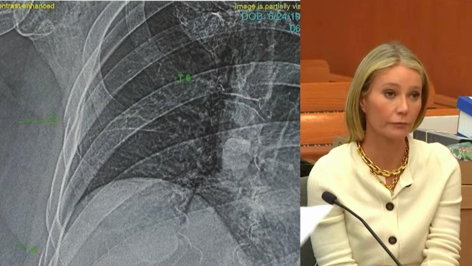 Gwyneth Paltrow Ski Accident Trial Shows Man’s X-Ray