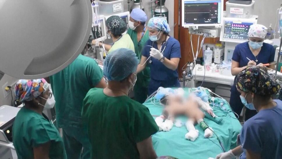 Conjoined twins in surgery