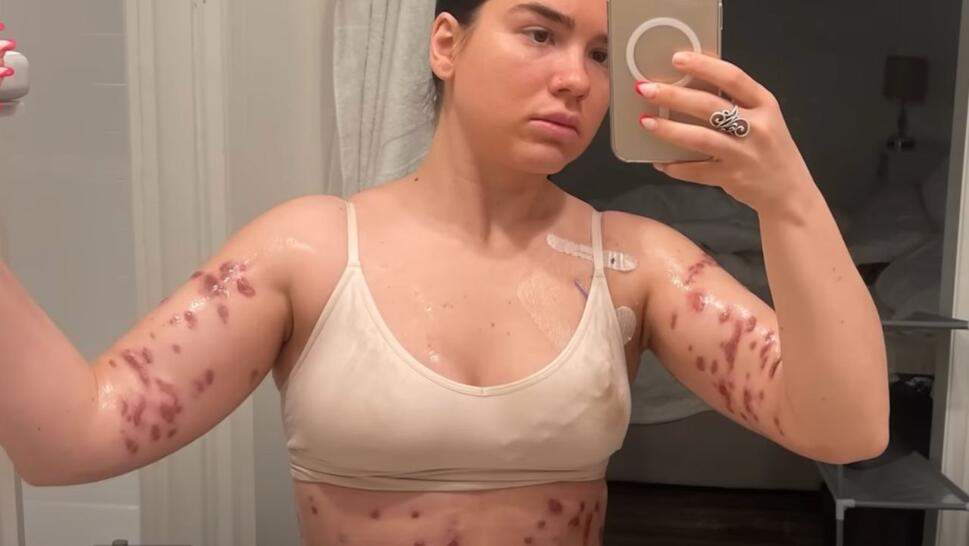 Beatriz Amma with skin lesions
