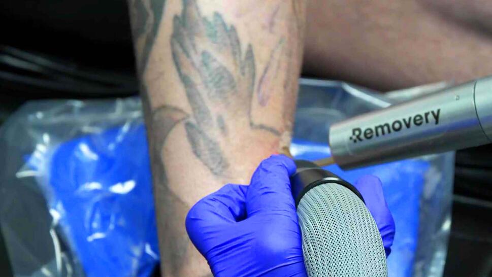 Doctor using laser to remove a tattoo on someone's forearm