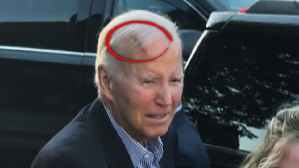Former President Joe Biden, a red circle around what appears to be a gash on his head