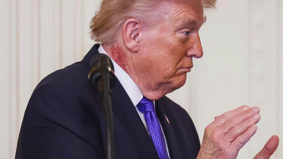 Side profile of United States President Donald Trump in a suit with a large red mark on his neck