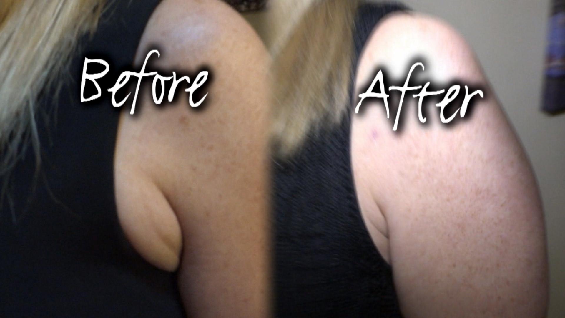 Armpit Fat Removal Surgery