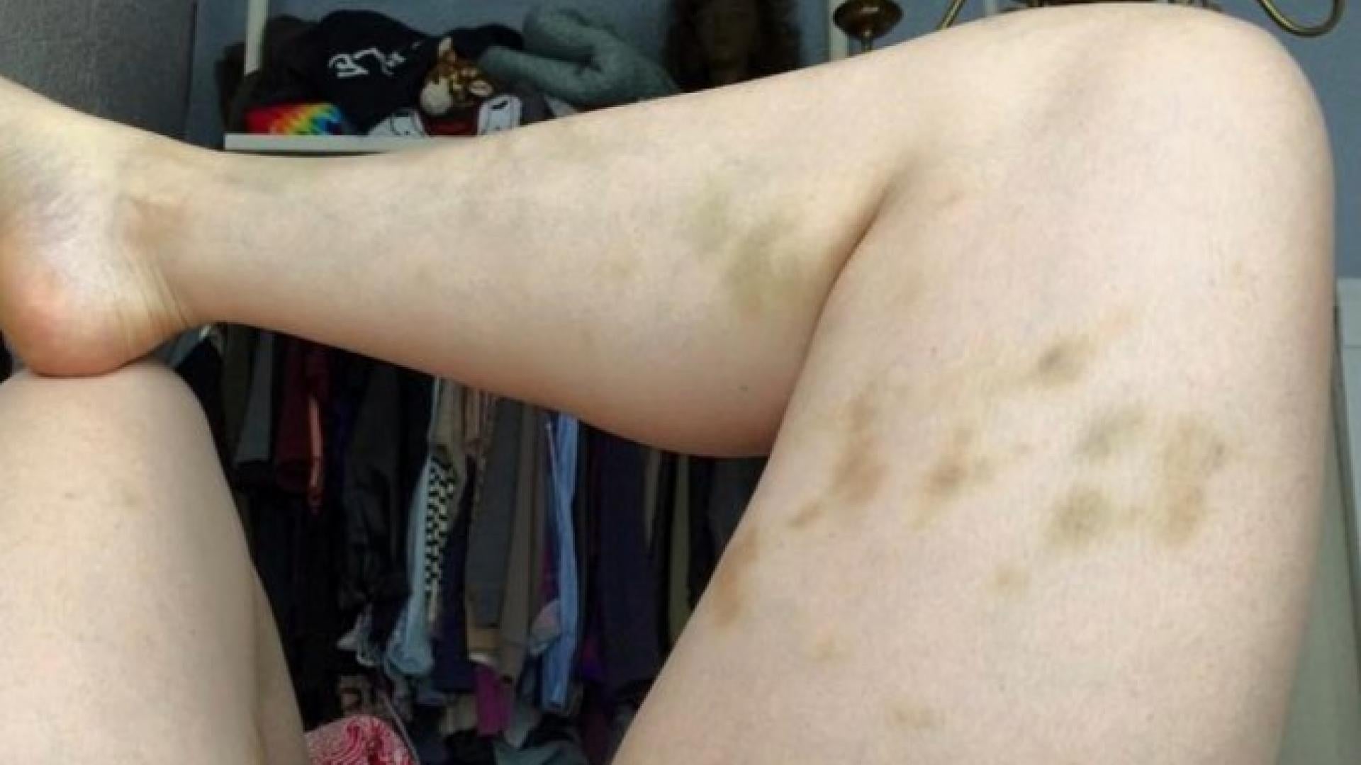 Bruises After Sex