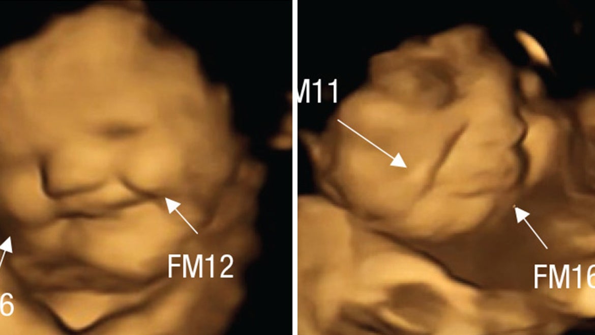 on left, ultrasound of fetus with a smile, on right, ultrasound of fetus with frown