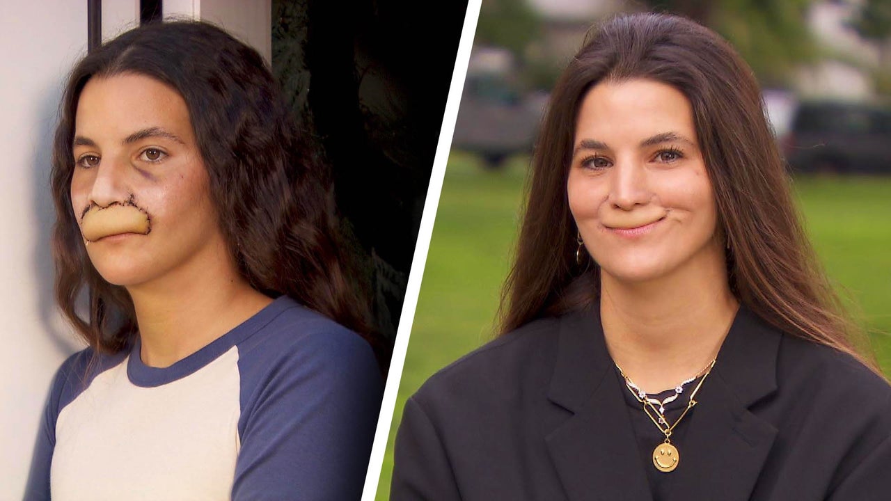 Model Brooklinn Khoury Has Six Surgeries to Repair Upper Lip After Dog